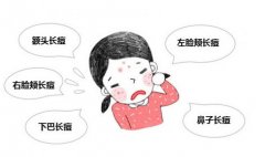 如何巧妙地避开青春痘